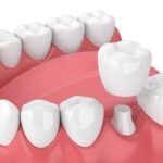 Dental Crown treatment